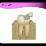 onlay