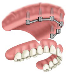Implant-dentar-Râmnicu-Sărat Implant-dentar-Râmnicu-Sărat Proteza pe implanturi proteza pe implanturi Proteza pe implanturi Implant dentar R mnicu S rat