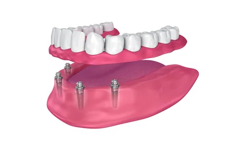 imapant-dentar-Stomatologie-Râmnicu-Sărat-Dr imapant-dentar-Stomatologie-Râmnicu-Sărat-Dr Proteza pe implanturi proteza pe implanturi Proteza pe implanturi imapant dentar Stomatologie R mnicu S rat Dr