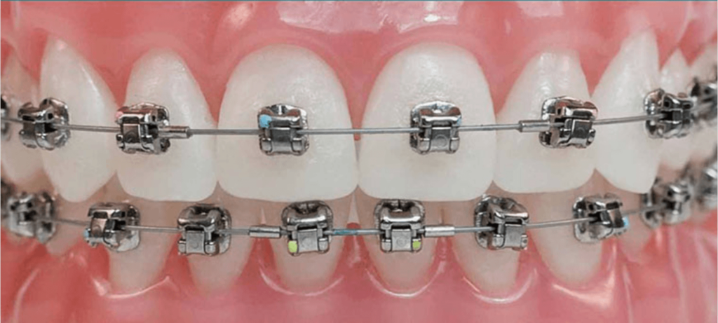 ortodontie-1024x461 ortodontie-1024x461 ORTODONTIE ortodontie ORTODONTIE – Estetic versus functional ortodontie 1024x461